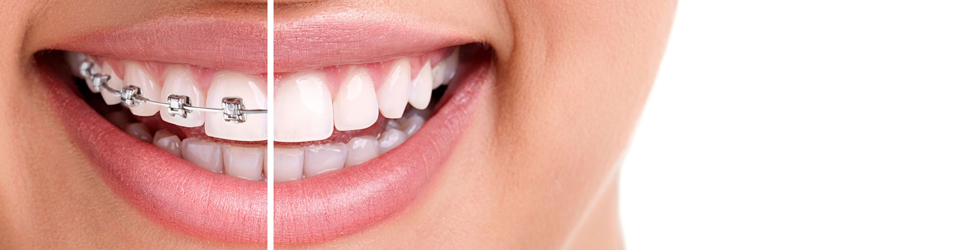 leczenie ortodontyczne Cieszyn